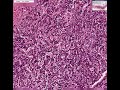Histopathology Adrenal gland--Primary chronic adrenal insuff