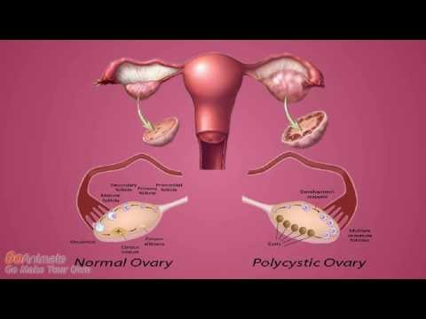 how to treat polycystic ovarian syndrome