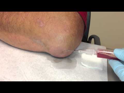 how to drain knee bursitis