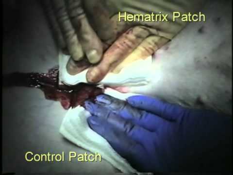 how to do epidural blood patch
