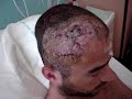 Mes blessures ! Alcool au volant ! (lire la description svp )