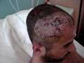 Mes Blessures ! Alcool Au Volant ! [lire La Description Svp ]