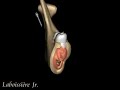 implante en mandibula