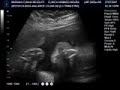 Ultrassom com 30 semanas e 