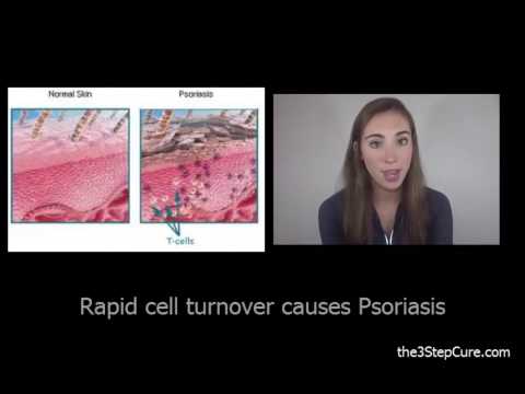 how to recognise eczema