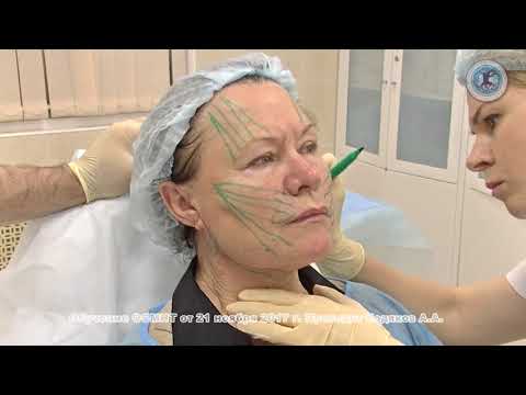 Установка нитей Soft Lift Invisible и Comfort | ОСМНТ Установка нитей Soft Lift Invisible и Comfort | ОСМНТ