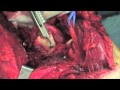 Distal End Humerus Tumor Excision With Prosthesis Insertion Distal End Humerus Tumor Excision With Prosthesis Insertion