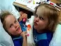 Conjoined Twins - Herrin Twins-Two lives Full of Miracles