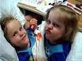 Conjoined Twins - Herrin Twins-Two lives Full of Miracles