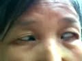 Strabismus