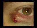 Stye and Chalazion in Children