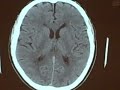 Normal CT
