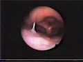 vocal cords
