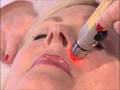 BeautyLight Light Therapy Face Lift