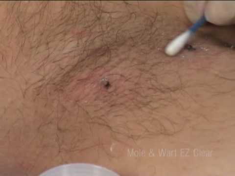 how to remove ez tag