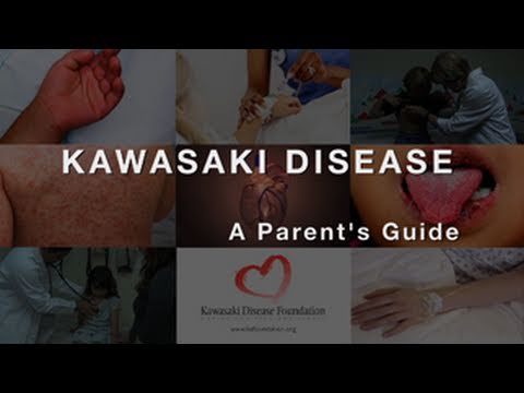 how to treat kawasaki disease