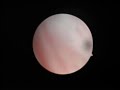 Polipo endometrial y sinequias cervicales