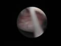 Polipo endometrial y sinequias cervicales