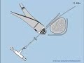 Lengthening over Nail, Gigli Saw osteotomy - Part 1