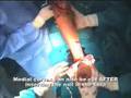 Lengthening over Nail, Gigli Saw osteotomy - Part 1