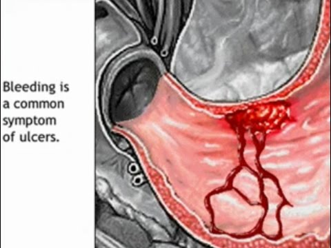 how to cure esophageal ulcers
