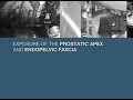 Weill Cornell Robotic Prostatectomy: Surgery (3/6) Weill Cornell Robotic Prostatectomy: Surgery (3/6)