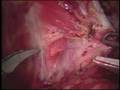 Weill Cornell Robotic Prostatectomy: Surgery (3/6)