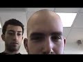 Beating Balding