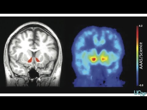 Drinking alcohol leads to the release of natural brain opioids in humans
