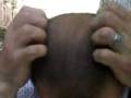 videos de bruciore di pupille