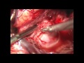 MCA fusiform aneurysm clipping that required EC-IC Bypass by Jon White, MD