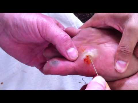 how to treat a blister on a foot