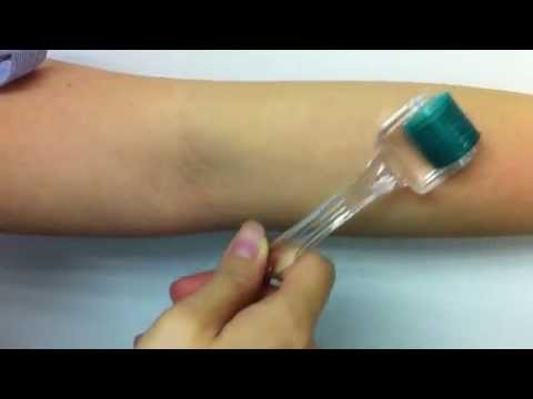 how to use a acne needle