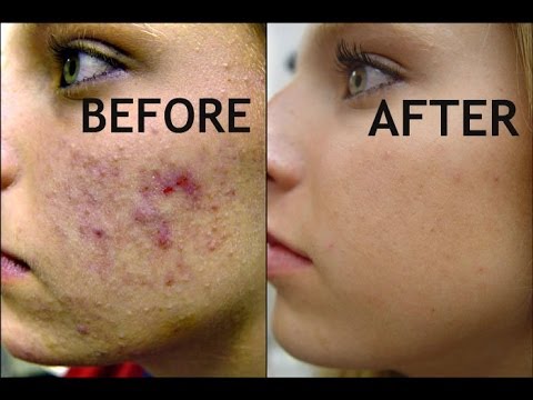 DIY Homemade Acne Face Masks