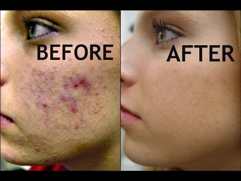 how to do acne facial