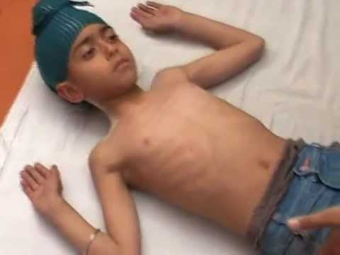 how to treat cerebral palsy