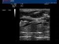 Tumescent Anesthesia , Sub-Dermal Tumescent Anesthesia , Sub-Dermal