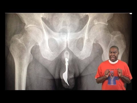Man Gets Fork Stuck In His Penis / Urethra ! ★DSVL★ (David Spates)