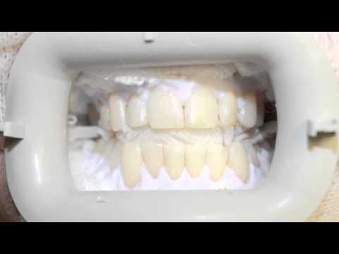 how to whiten dentin