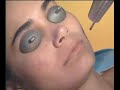 Laser Skin Rejuvenation and Anti-Aging Maintenance with the MedLite