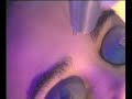 Laser Skin Rejuvenation and Anti-Aging Maintenance with the MedLite