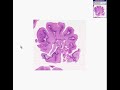 histopathology vulva --condyloma accuminata (viral induced squamous papilloma)