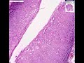 Histopathology Vulva --Condyloma accuminata (viral induced s