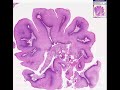 histopathology vulva --condyloma accuminata (viral induced squamous papilloma)