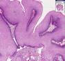 Histopathology Vulva --Condyloma accuminata (viral induced s