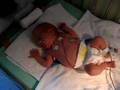 Emma - 36 weeks - NICU pt1