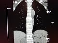 CT scan of a Compression fracture of the Thoracic Spine