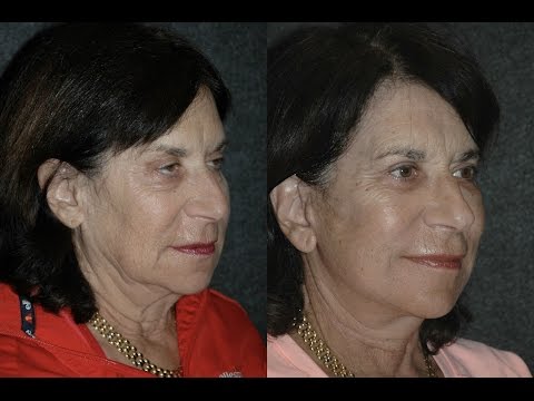 how to repair ptosis