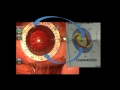 Marking and placement of a toric intraocular lens