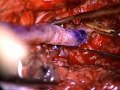 Creation Of Bypass Between Carotid And Vertebral Artery In Case Of Aneurysms Creation Of Bypass Between Carotid And Vertebral Artery In Case Of Aneurysms